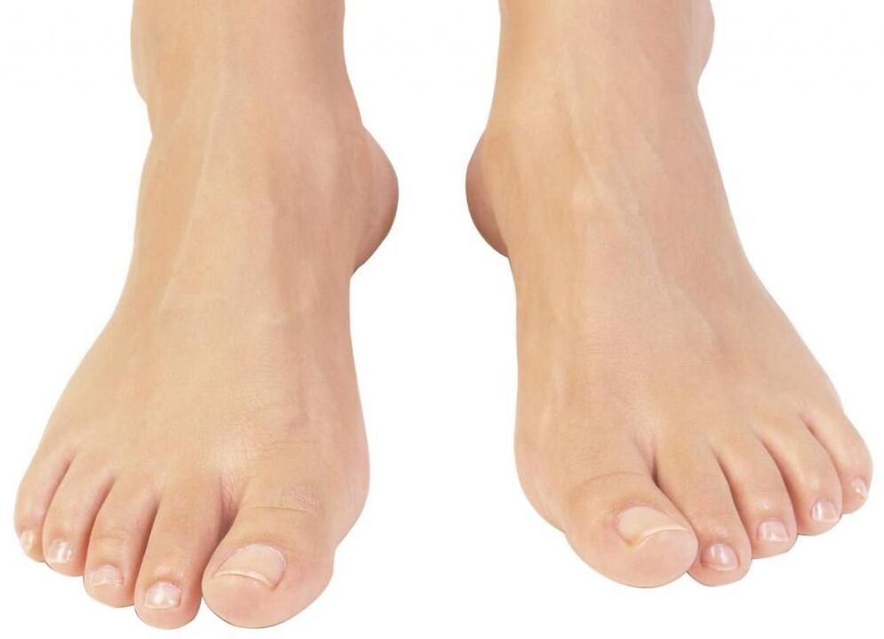 zdravi nohti na nogah po zdravljenju z glivicami