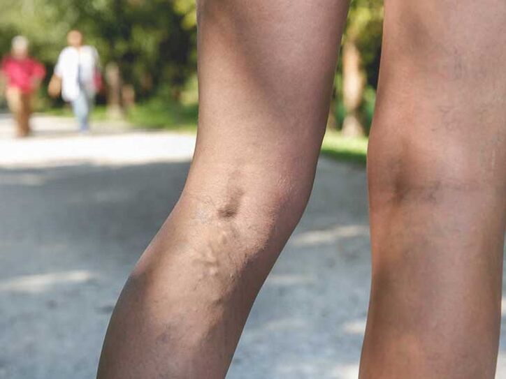 Krčne žile so dejavnik tveganja za glivično okužbo stopal