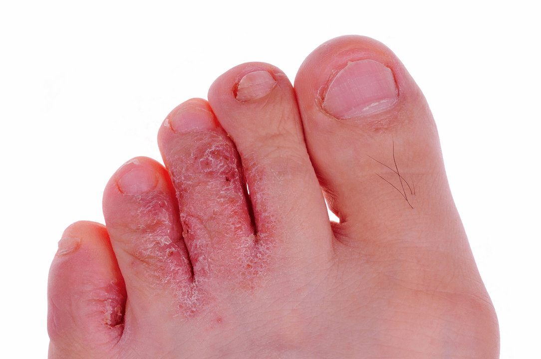 glivična okužba kože med prsti