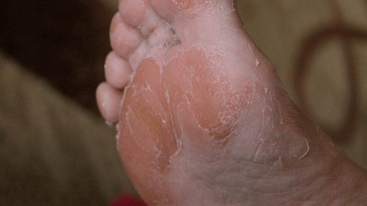kožne glivice stopal