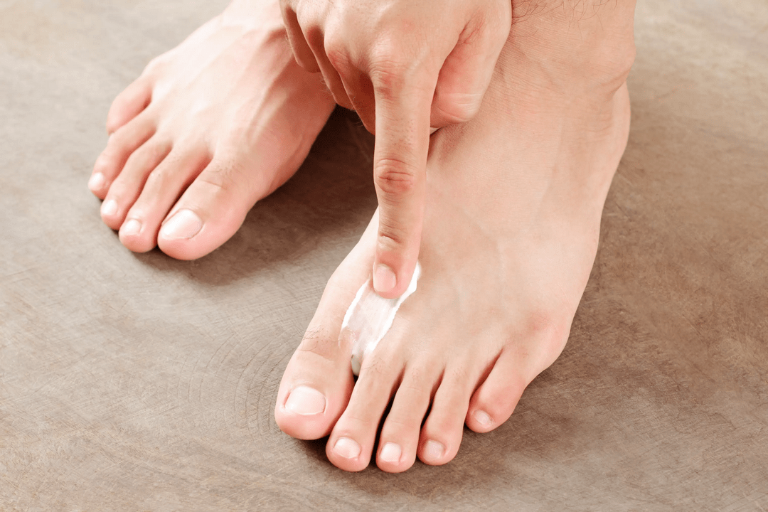 nanašanje protiglivičnega mazila na kožo stopal