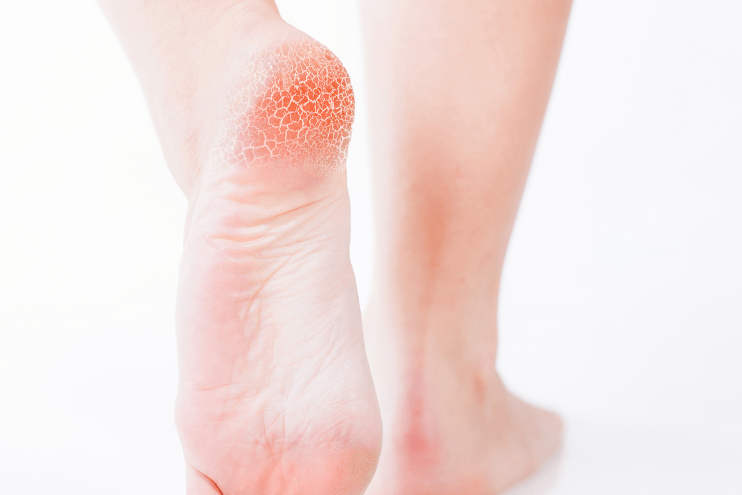 zdravljenje glivic na stopalih v začetni fazi