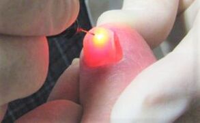 Zdravljenje gliv za nohte z laserjem