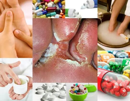 Interdigitalna mikoza in metode zdravljenja