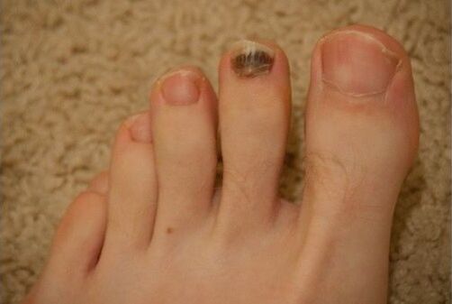 Uporaba peroralnih in lokalnih zdravil