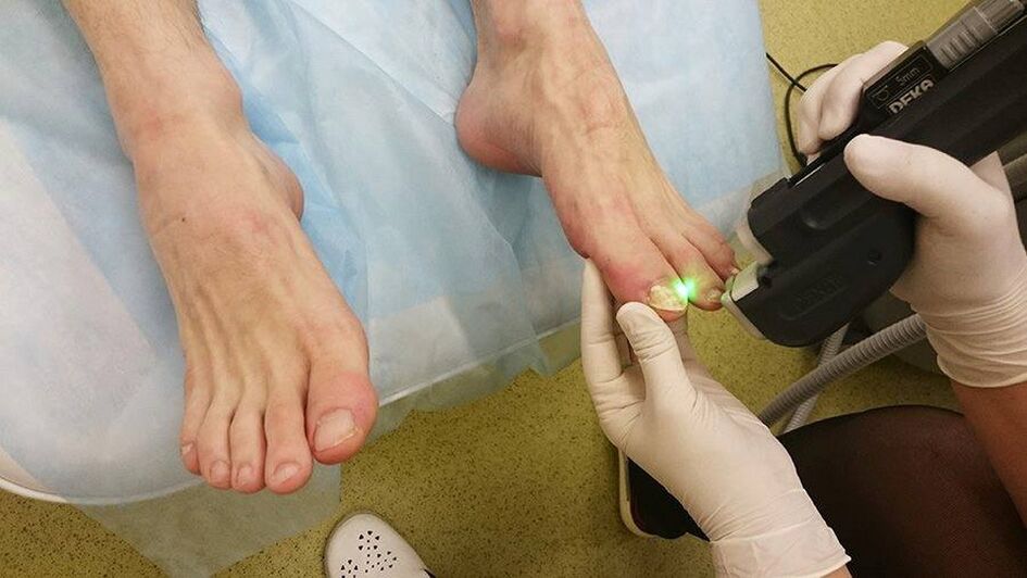 laserska terapija za glivice na nohtih